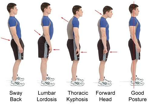 Qué es una lordosis y cómo tratarla.